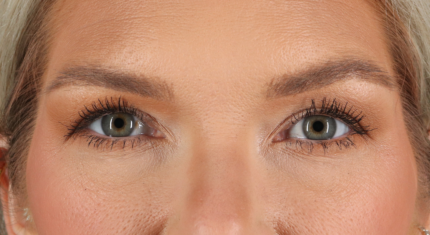 Blepharoplasty (Eyelid Surgery) Before & After Patient #4870