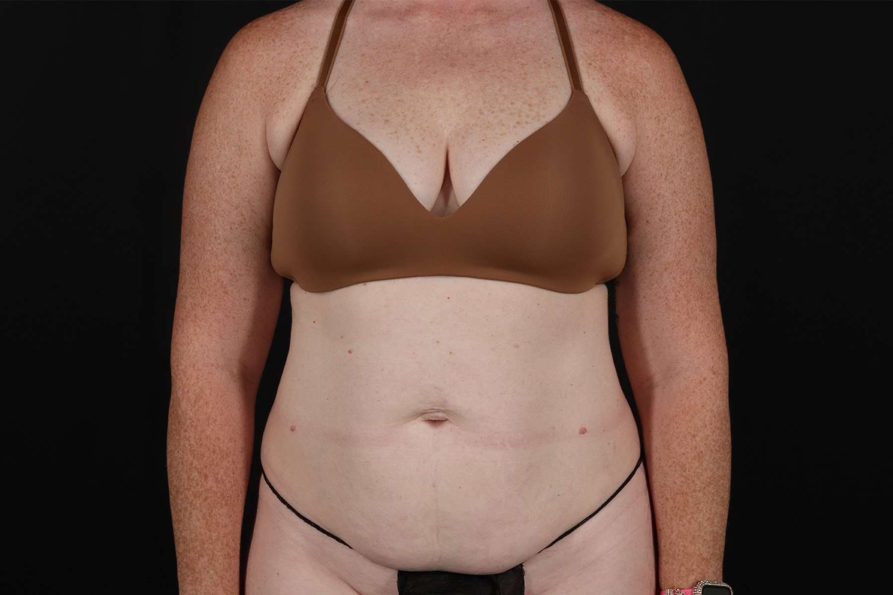 Tummy Tuck Before & After Patient #4871