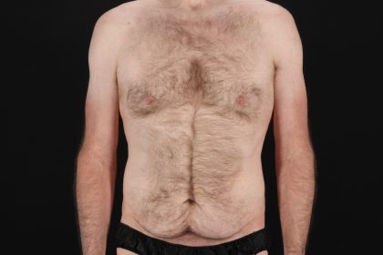 Quantum Rf Before & After Patient #4948