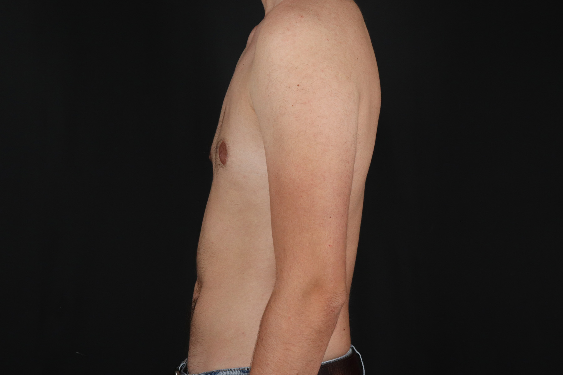 FTM Chest Contouring Before & After Patient #4872