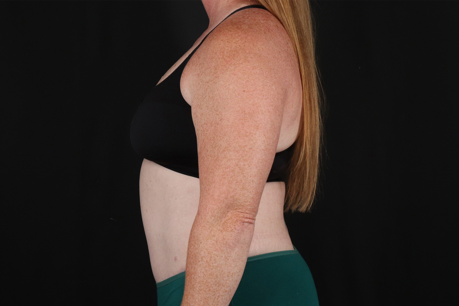 Tummy Tuck Before & After Patient #4871