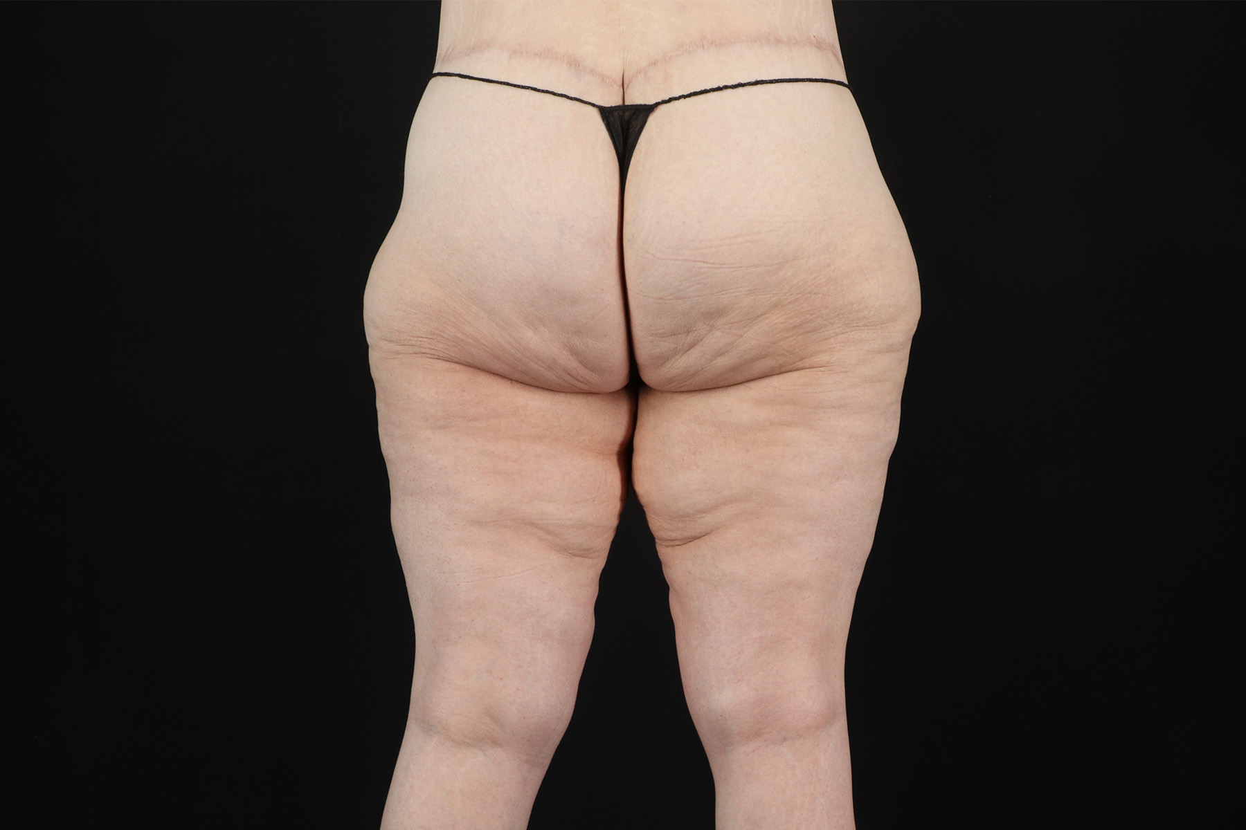 Massive Weight Loss Before & After Patient #5050
