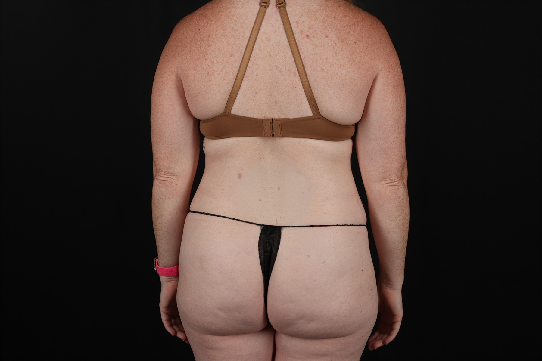 Tummy Tuck Before & After Patient #4871