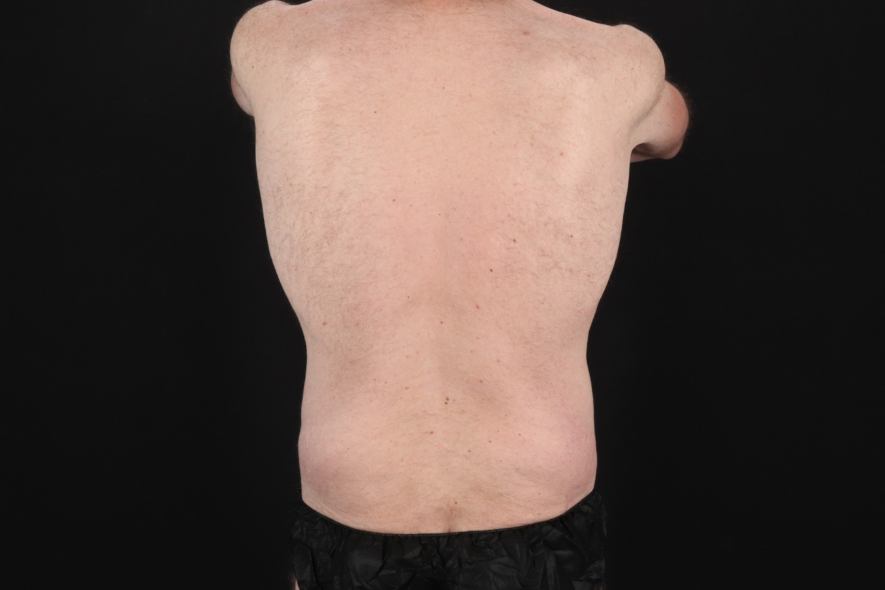 Quantum Rf Before & After Patient #4948
