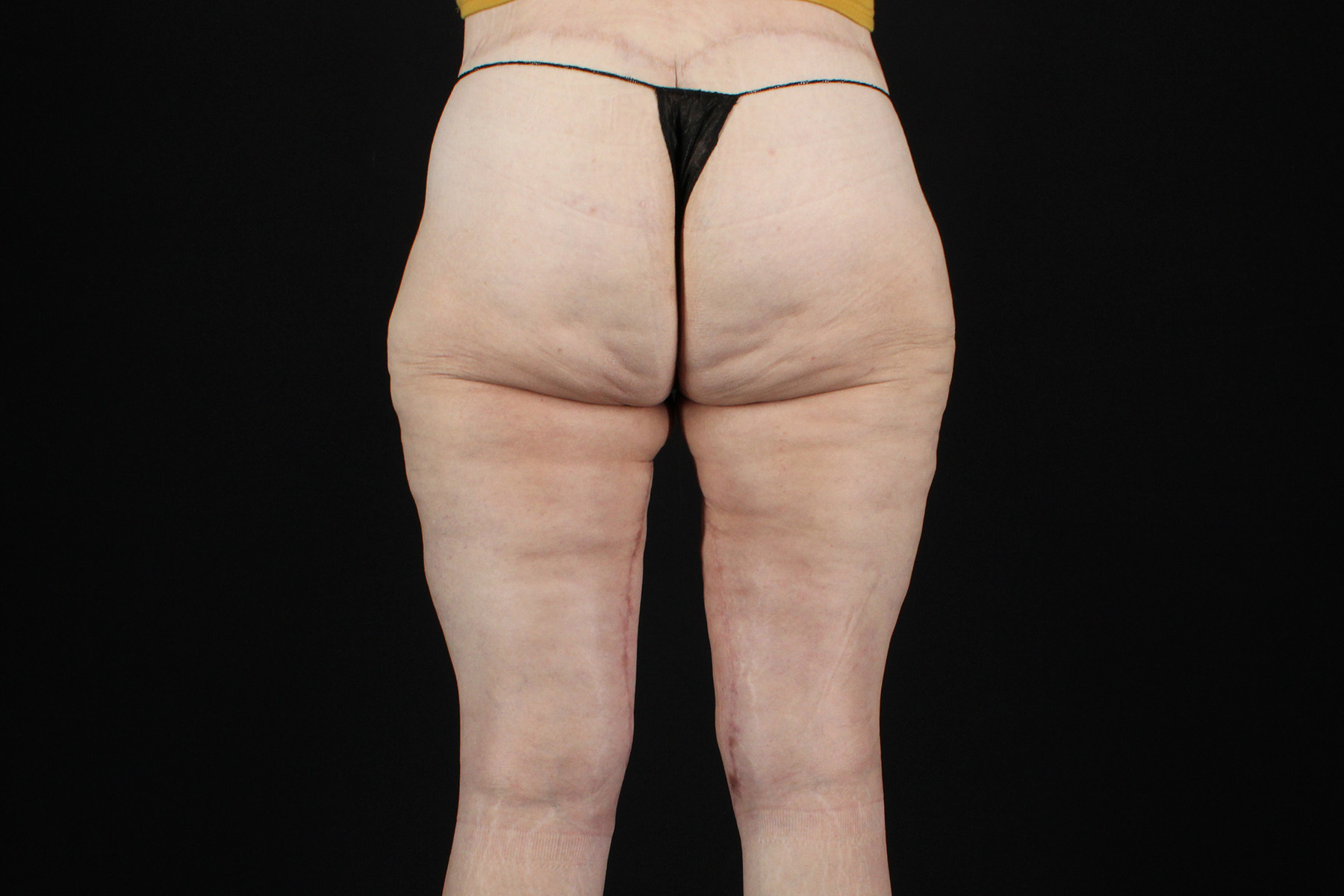 Massive Weight Loss Before & After Patient #5050