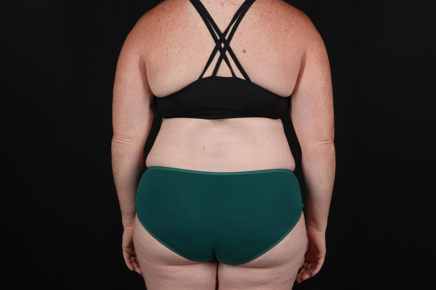 Tummy Tuck Before & After Patient #4871