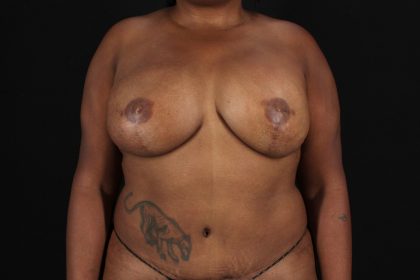 DIEP Flap Reconstruction Before & After Patient #4866