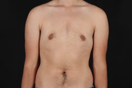 FTM Chest Contouring Before & After Patient #4872