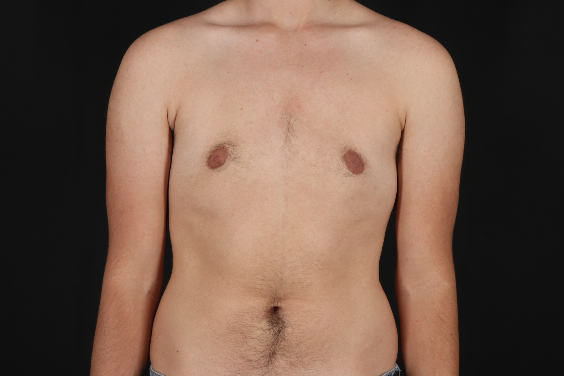 FTM Chest Contouring Before & After Patient #4872