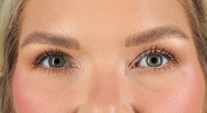 Blepharoplasty (Eyelid Surgery) Before & After Patient #4870