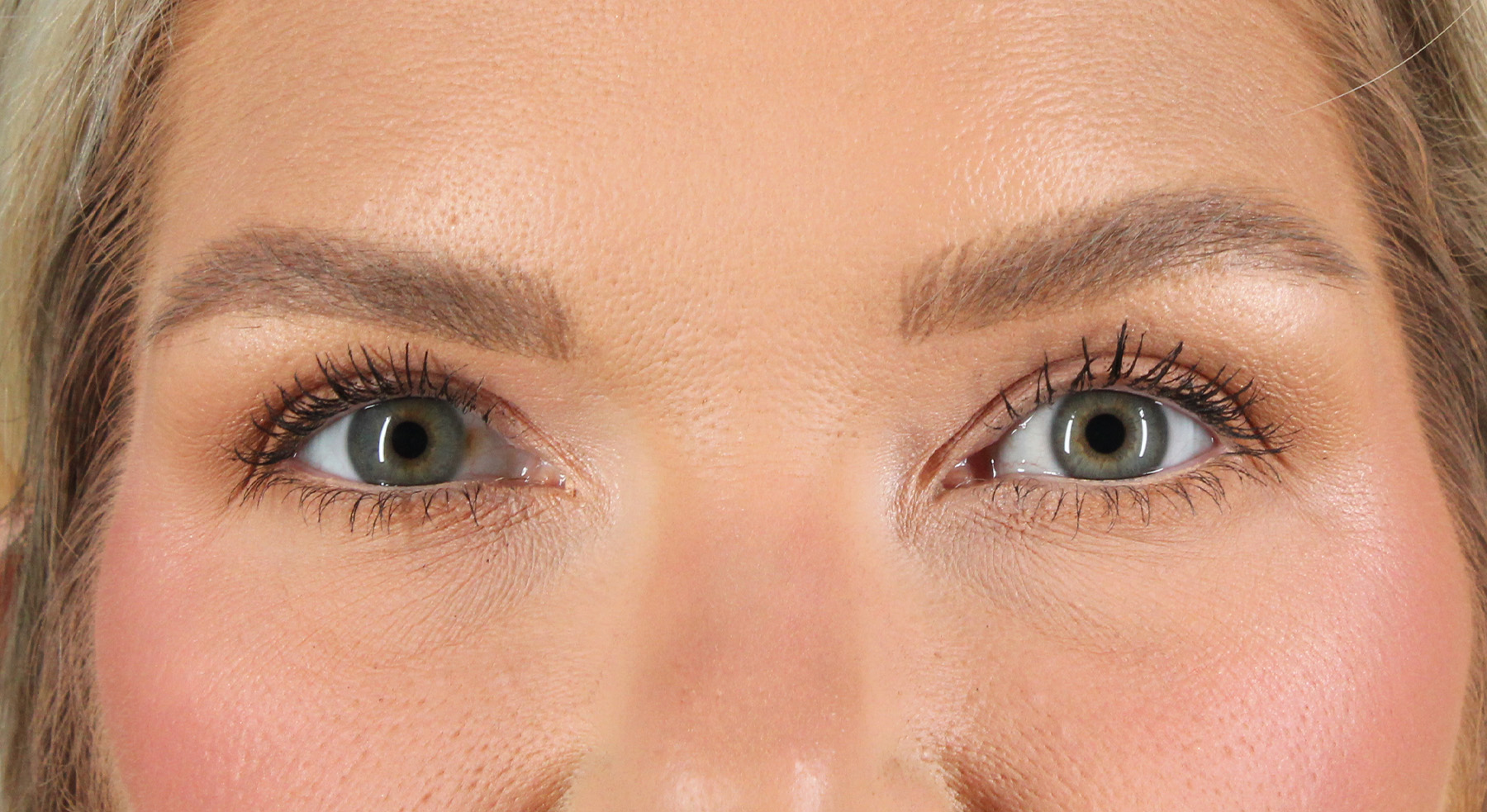 Blepharoplasty (Eyelid Surgery) Before & After Patient #4870