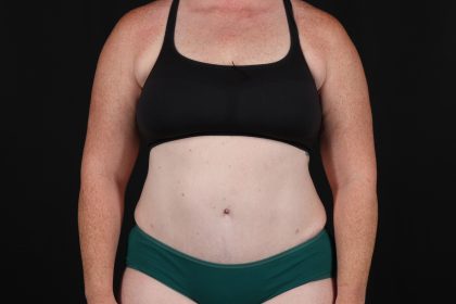 Tummy Tuck Before & After Patient #4871