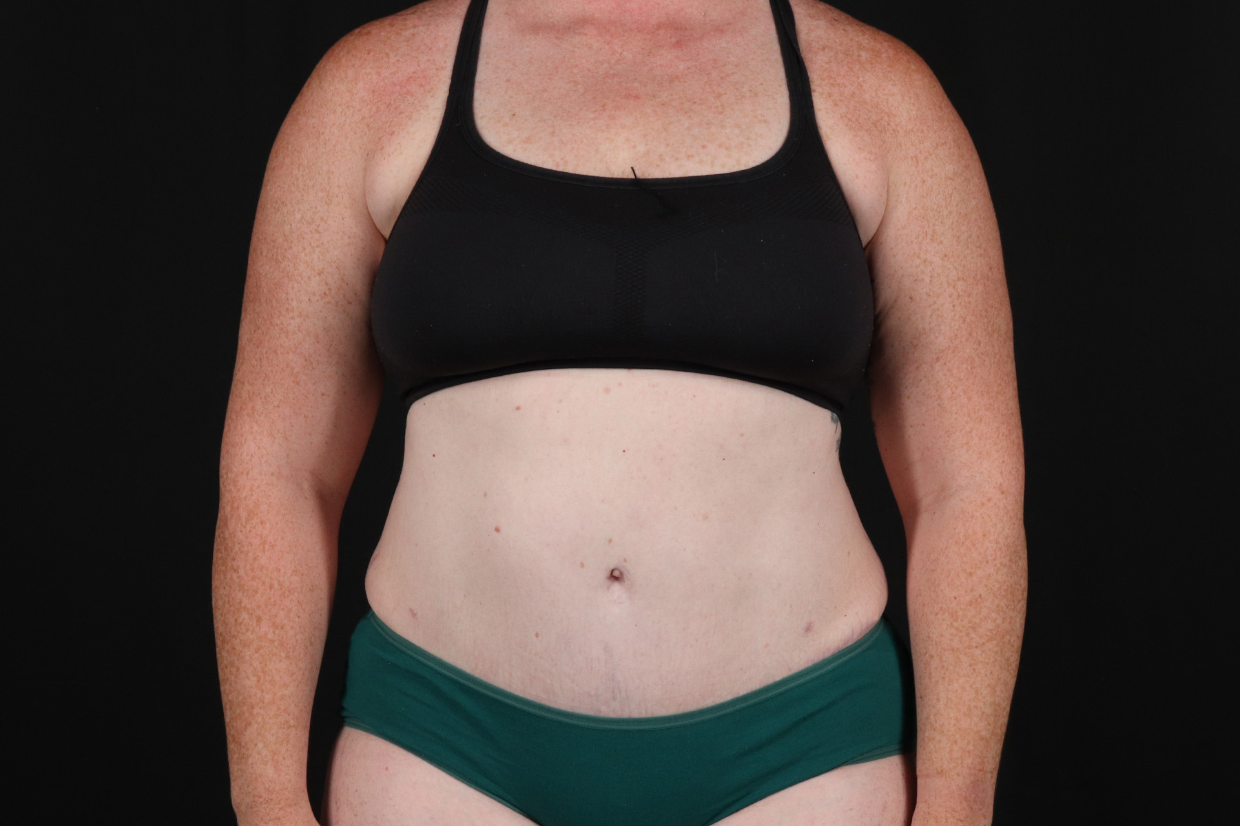 Tummy Tuck Before & After Patient #4871