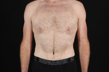 Quantum Rf Before & After Patient #4948