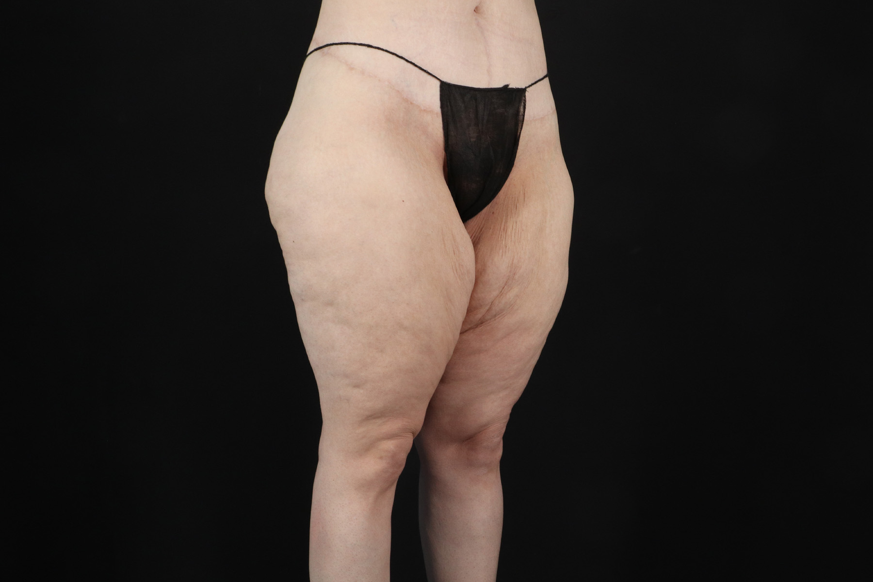 Massive Weight Loss Before & After Patient #5050