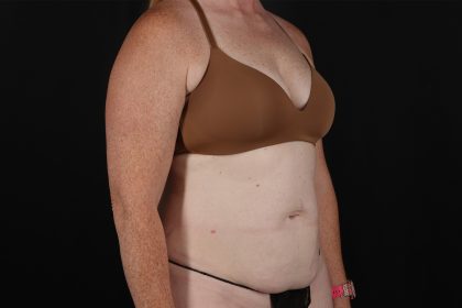 Tummy Tuck Before & After Patient #4871
