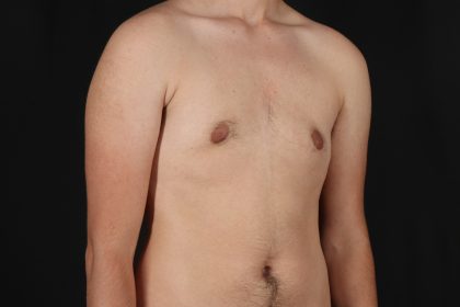 FTM Chest Contouring Before & After Patient #4872