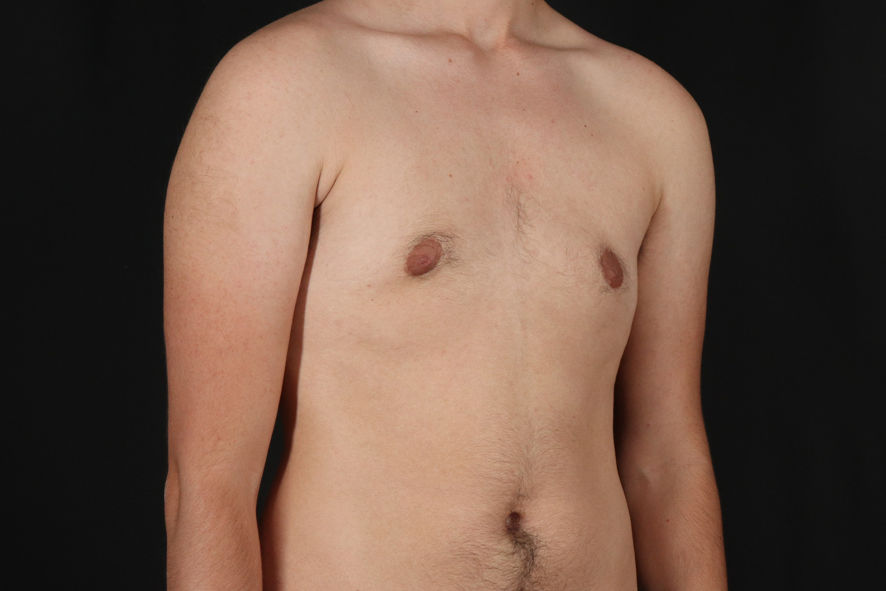 FTM Chest Contouring Before & After Patient #4872