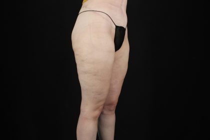 Massive Weight Loss Before & After Patient #5050