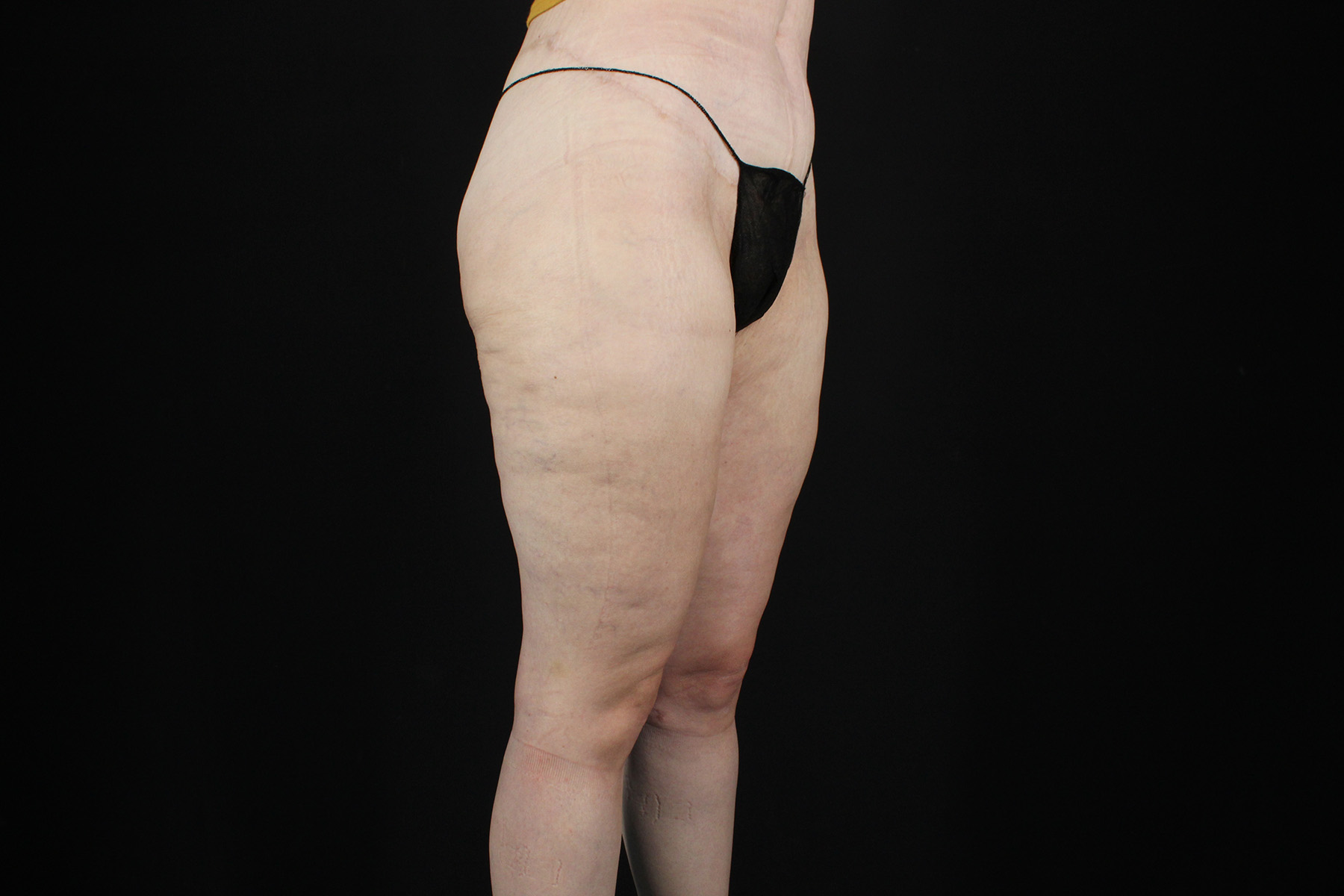 Massive Weight Loss Before & After Patient #5050
