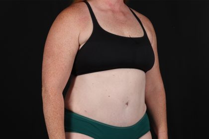 Tummy Tuck Before & After Patient #4871