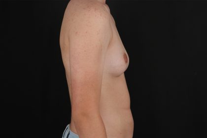 FTM Chest Contouring Before & After Patient #4872