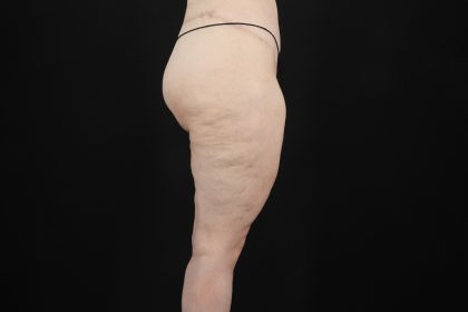 Massive Weight Loss Before & After Patient #5050