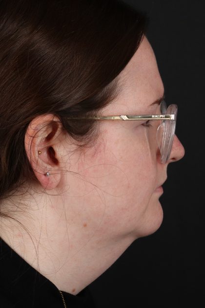 Quantum Rf Before & After Patient #4874
