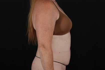Tummy Tuck Before & After Patient #4871
