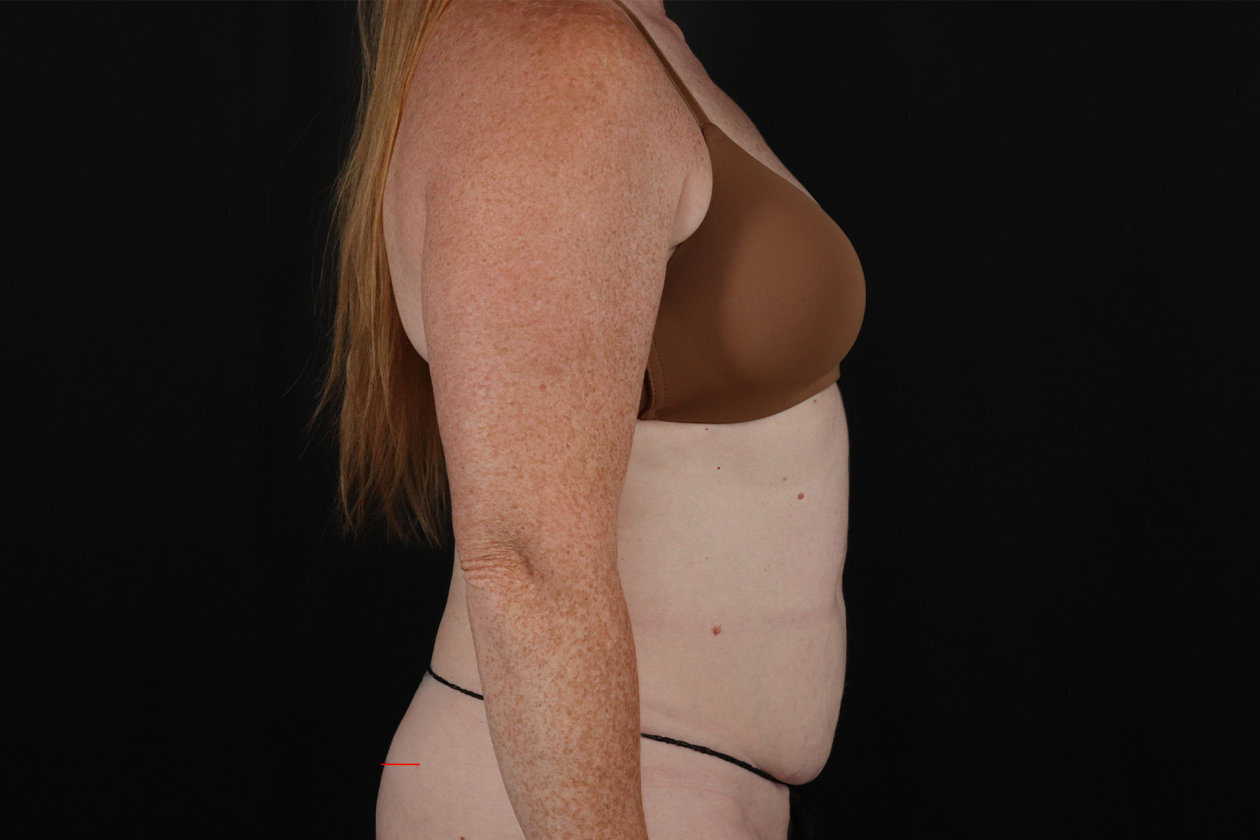 Tummy Tuck Before & After Patient #4871