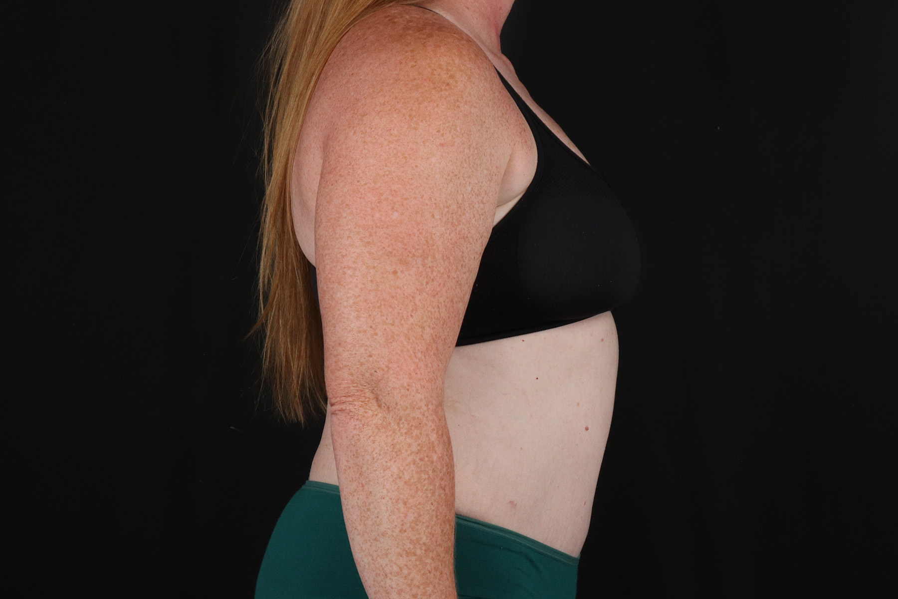 Tummy Tuck Before & After Patient #4871