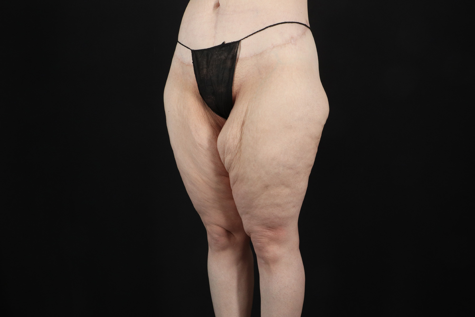 Massive Weight Loss Before & After Patient #5050