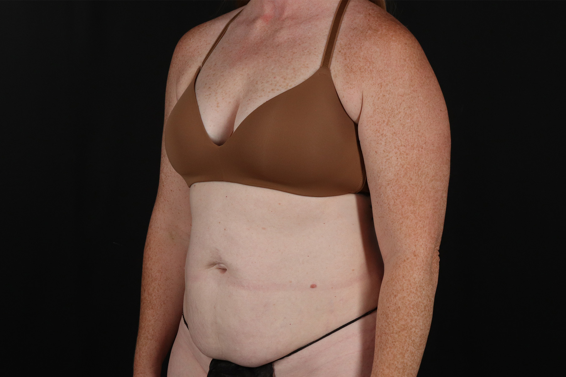 Tummy Tuck Before & After Patient #4871