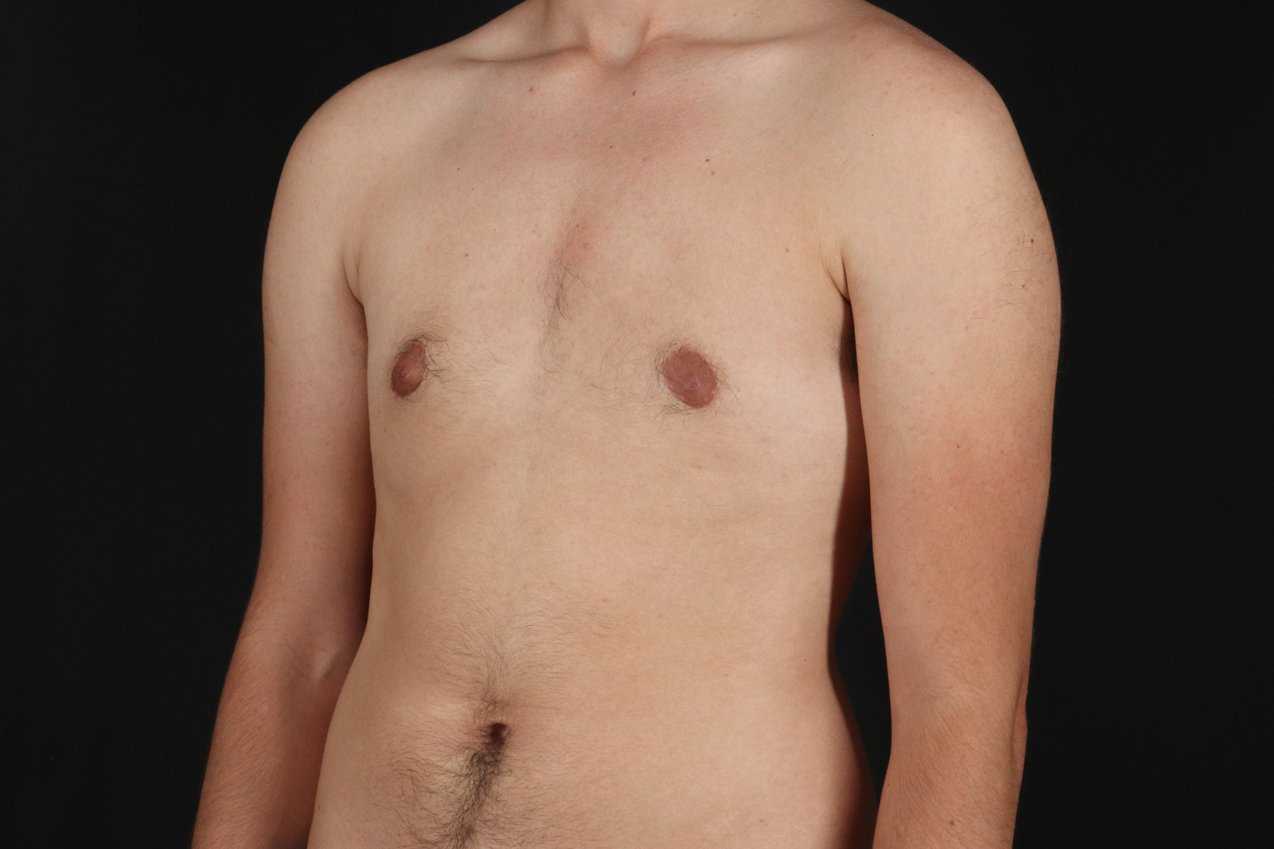 FTM Chest Contouring Before & After Patient #4872