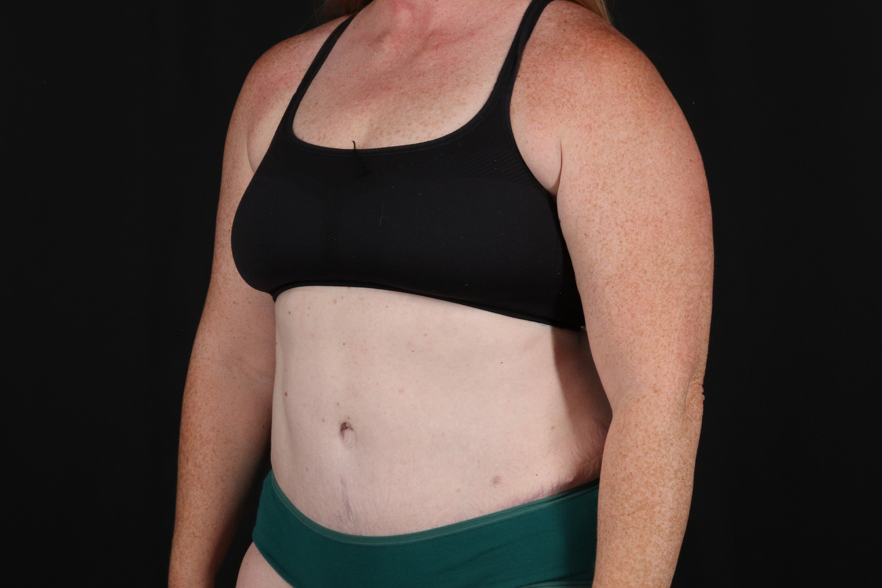 Tummy Tuck Before & After Patient #4871