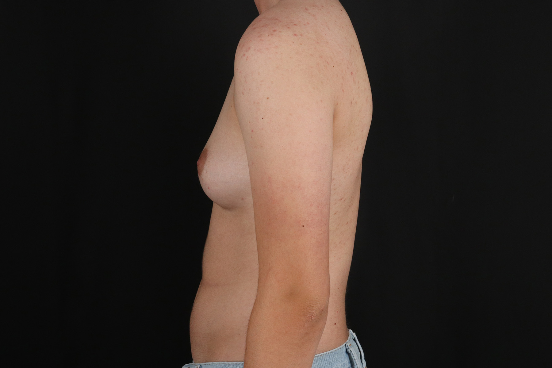 FTM Chest Contouring Before & After Patient #4872