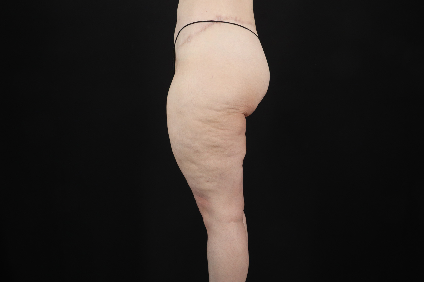 Massive Weight Loss Before & After Patient #5050
